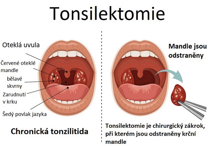 Tonsilektomie - ilustrace