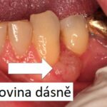 Rakovina dásní – dá se léčit? Příznaky, příčiny, léčba, obrázky