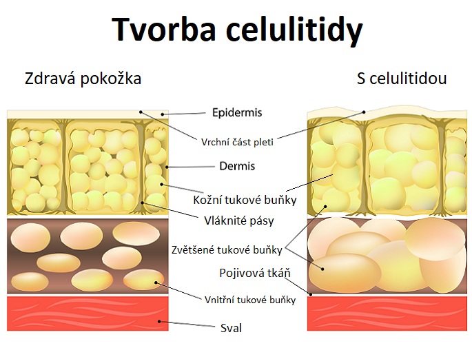 Obrázek: zdravá pokožka x pokožka s celulitidou