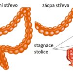 Chronická zácpa – jak na ni? Příznaky, příčiny a léčba