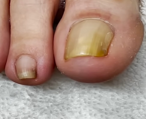 Jak se dají léčit žluté nehty?