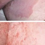 Tinea cruris – plísňová infekce třísel – příznaky, příčiny a léčba