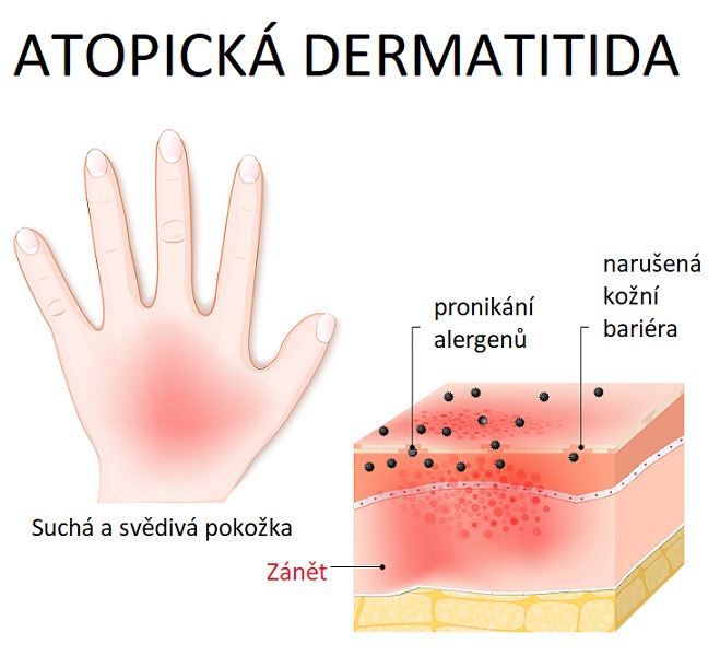 Atopická dermatitida