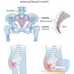 Bolesti v oblasti kostrče (kokcydynie) – příznaky, příčiny a léčba