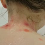 Nemoc motýlích křídel či Epidermolysis bullosa congenita (EBC, EB) – příznaky, příčiny a léčba