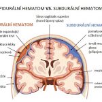 Epidurální hematom – co je to – příznaky, příčiny a léčba