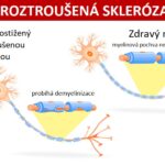 Příznaky roztroušené sklerózy – jak jim porozumět