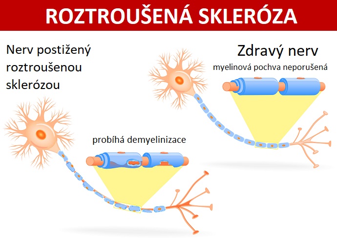 Zdravý nerv x Nerv postižený roztroušenou sklerózou