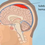 Subdurální hematom – co je to – příznaky, příčiny a léčba
