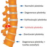 Jak se dá cvičit při vyhřezlé ploténce?