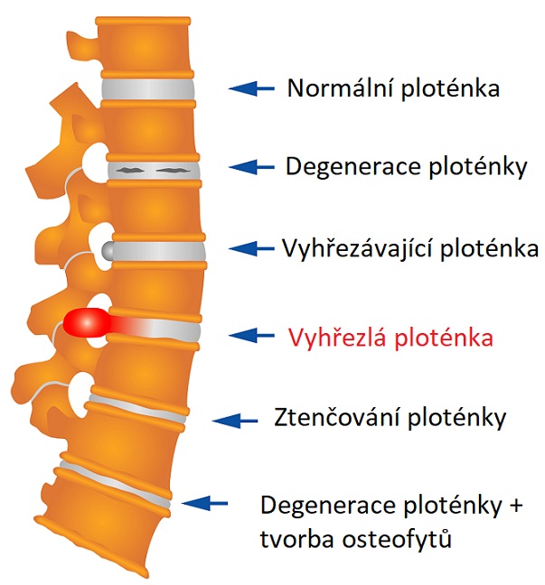 Jak vypadá vyhřeznutí ploténky?