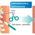 Laminektomie – co je to a kdy se provádí?