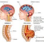 Chiariho malformace – co je to – příznaky, příčiny, léčba (operace)