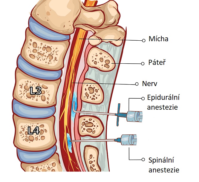 Epidurální anestezie vs. spinální anestezie