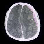 Herniace mozku – co je to – příznaky, příznaky, léčba