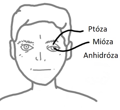 Příznaky Hornerova syndromu obvykle postihují pouze jednu stranu vašeho obličeje