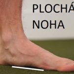 Ploché nohy – příčiny, příznaky, léčba a cvičení