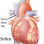 Syndrom horní duté žíly – co je to – příznaky, příčiny a léčba