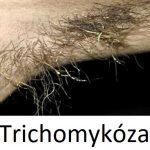 Trichomykóza – co je to – příznaky, příčiny a léčba