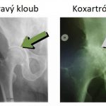 Koxartróza (artróza kyčelního kloubu) – co je to – příčiny, příznaky a léčba