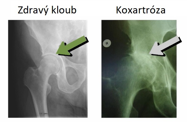 Koxartróza - porovnání se zdravým kloubem