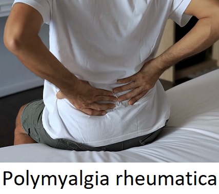 Polymyalgia rheumatica je autoimunitní onemocnění charakterizované zánětem svalů, zejména v oblasti ramen, krku, páteře a boků.