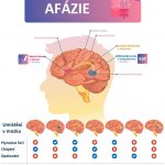 Afázie po mrtvici – co se dá dělat + tipy pro komunikaci