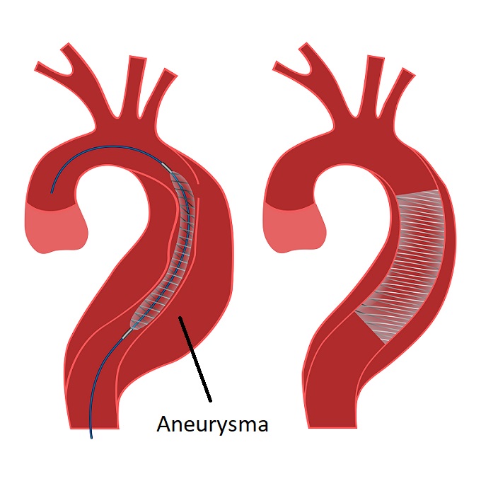 Stentgraft - aneurysma aorty