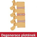 Diskopatie – degenerativní onemocnění plotének – příznaky, příčiny a léčba