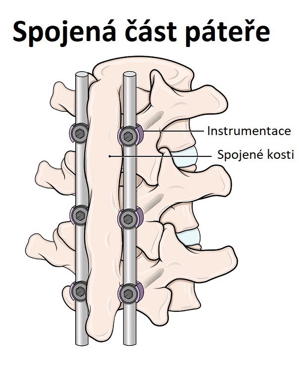 Ilustrace - spinální fúze