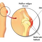 10+ cviků na hallux valgus (vbočené palce)