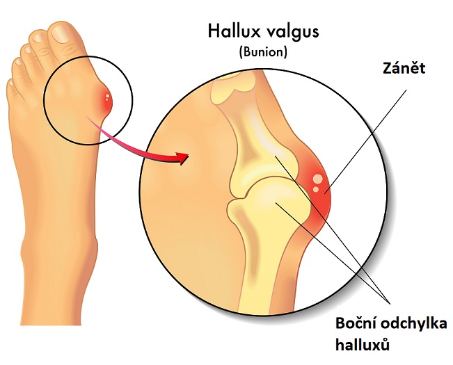 Hallux valgus - ilustrace