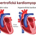 Hypertrofická kardiomyopatie – co je to – příznaky, příčiny a léčba