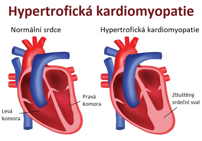 Hypertrofická kardiomyopatie - ilustrace