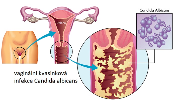 Ilustrace - vaginální kvasinková infekce Candida albicans
