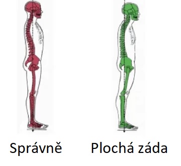 Plochá záda patří mezi poruchy osového systému těla