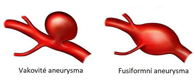 Aneurysma - typ