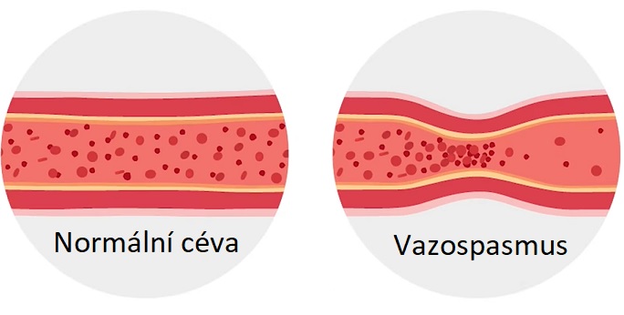 Vazospasmus - ilustrace