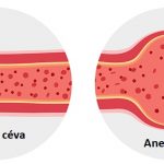 Aneurysma aorty – co je to – příznaky, příčiny a léčba