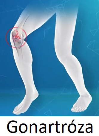 Gonartróza (artróza kolene) se projevuje celou řadou příznaků – bolestí, ztuhlostí, změnou postavení kloubu či ztrátou stability kolene.