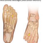 Mortonova neuralgie (Mortonův neurom) – co je to – příznaky, příčiny a léčba