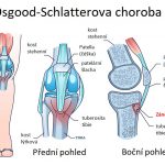 Osgood-Schlatterova choroba – co je to – příznaky, příčiny a léčba