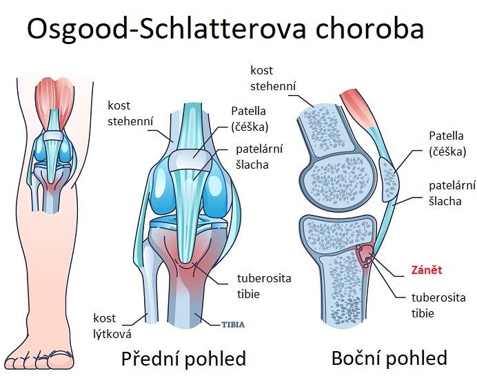 Osgood-Schlatterova choroba - ilustrace