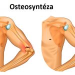 Osteosyntéza – co je to a jak se provádí?
