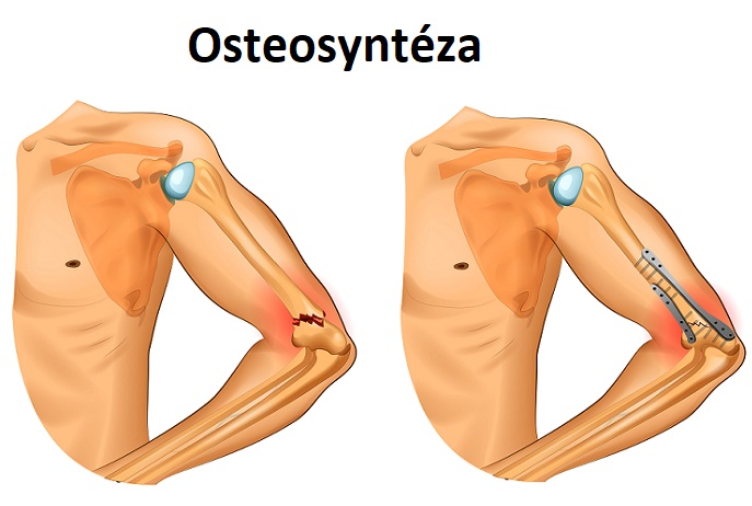 Osteosyntéza - ilustrace