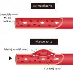 Disekce aorty – narušení vrstev aorty – příznaky, příčiny a léčba