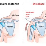 Dislokace kosti či kloubu – co je to a jak dislokaci opravit?