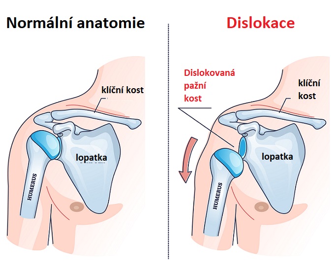 Dislokace - ilustrace
