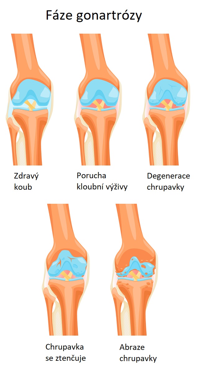 Fáze gonartrózy - ilustrace