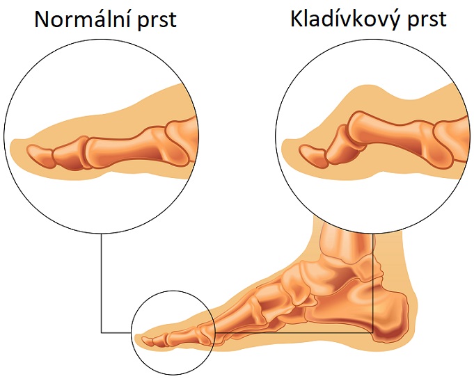 Kladívkový prst - ilustrace